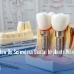How Do Screwless Dental Implants Work