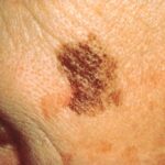 The Latest Trends in Dermatology for Skin Cancer Detection