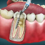 What Happens During a Root Canal Procedure and Aftercare