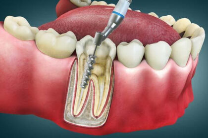 What Happens During a Root Canal Procedure and Aftercare