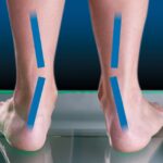 Flat Feet and Posture: How Poor Arch Support Affects Your Body