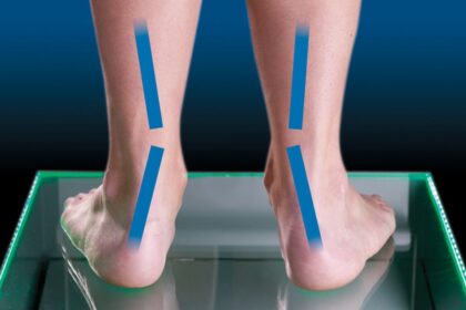 Flat Feet and Posture: How Poor Arch Support Affects Your Body