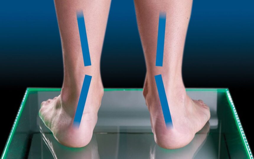 Flat Feet and Posture: How Poor Arch Support Affects Your Body
