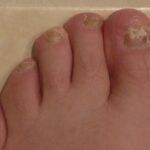 Symptoms and Treatment Options of Fungal Nails