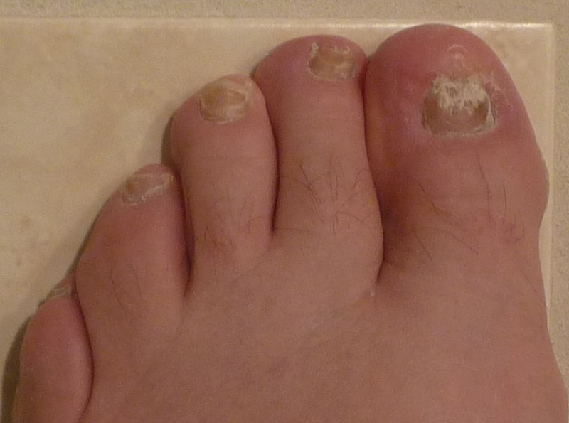 Symptoms and Treatment Options of Fungal Nails